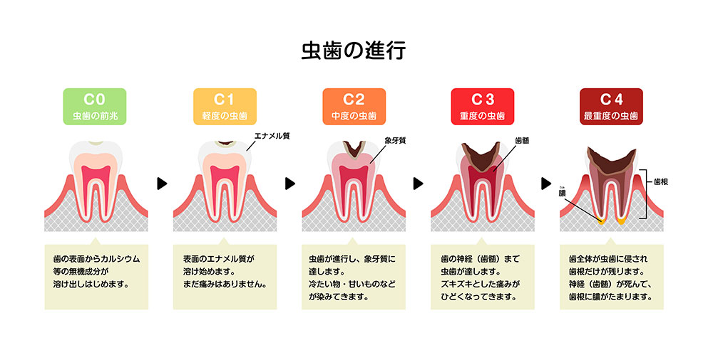 むし歯(虫歯)の進行度とおもな治療法