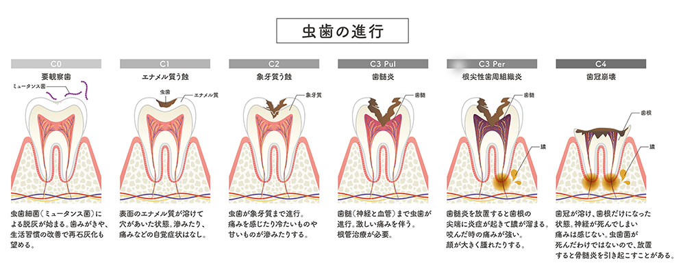むし歯(虫歯)の進行度とおもな治療法