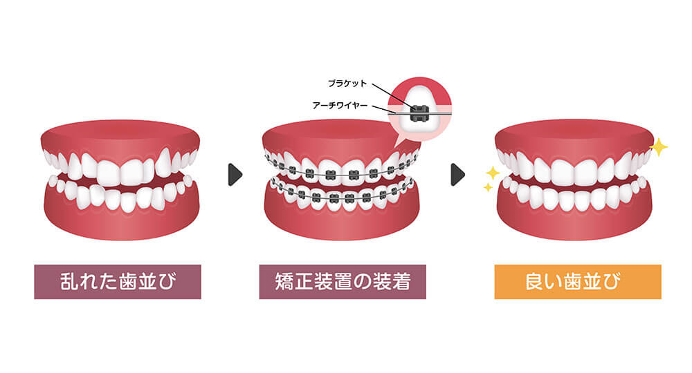 矯正歯科の流れ